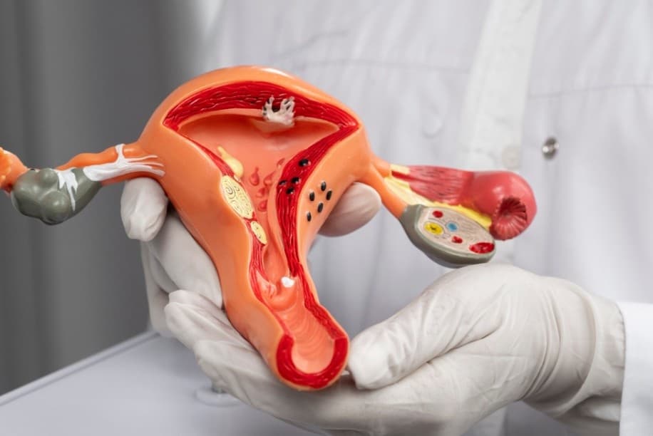 Kista Endometriosis: Penyebab, Gejala, dan Cara Mendeteksinya Sejak Dini