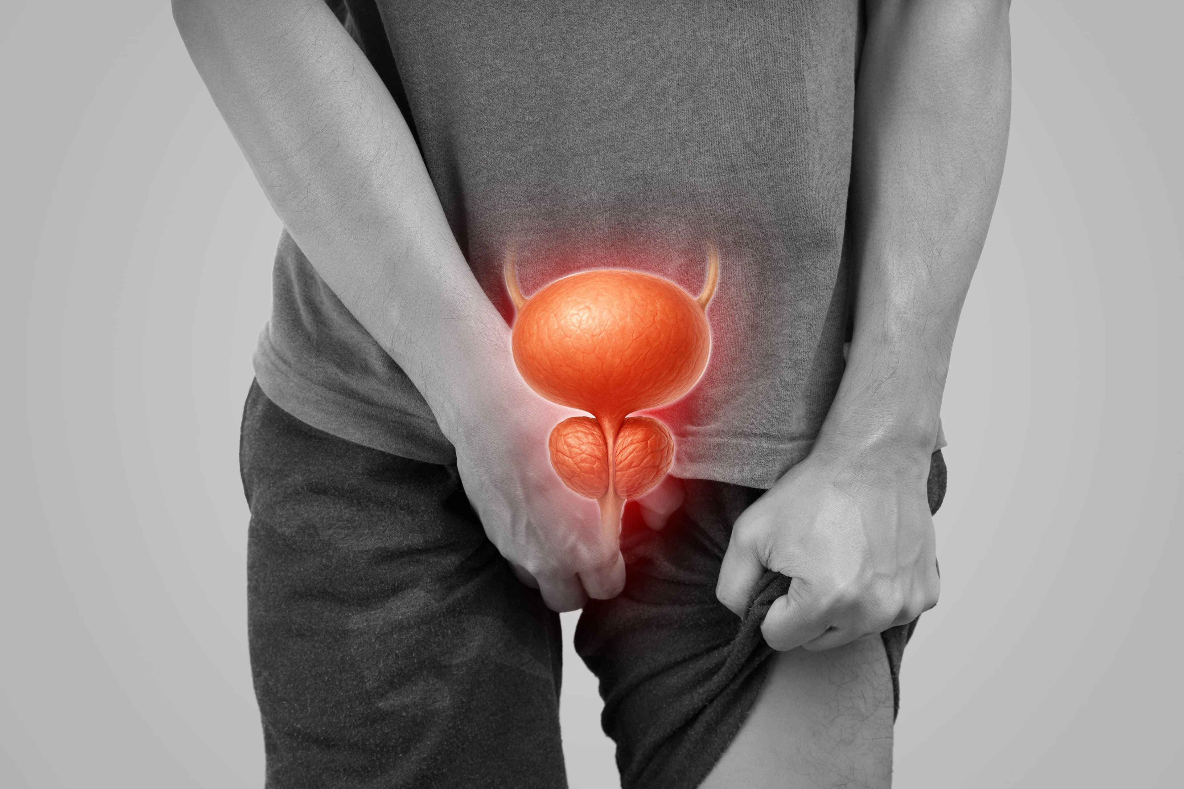 Pemeriksaan Skrining Kanker Prostat di Bumame untuk Deteksi Dini Kesehatan Pria