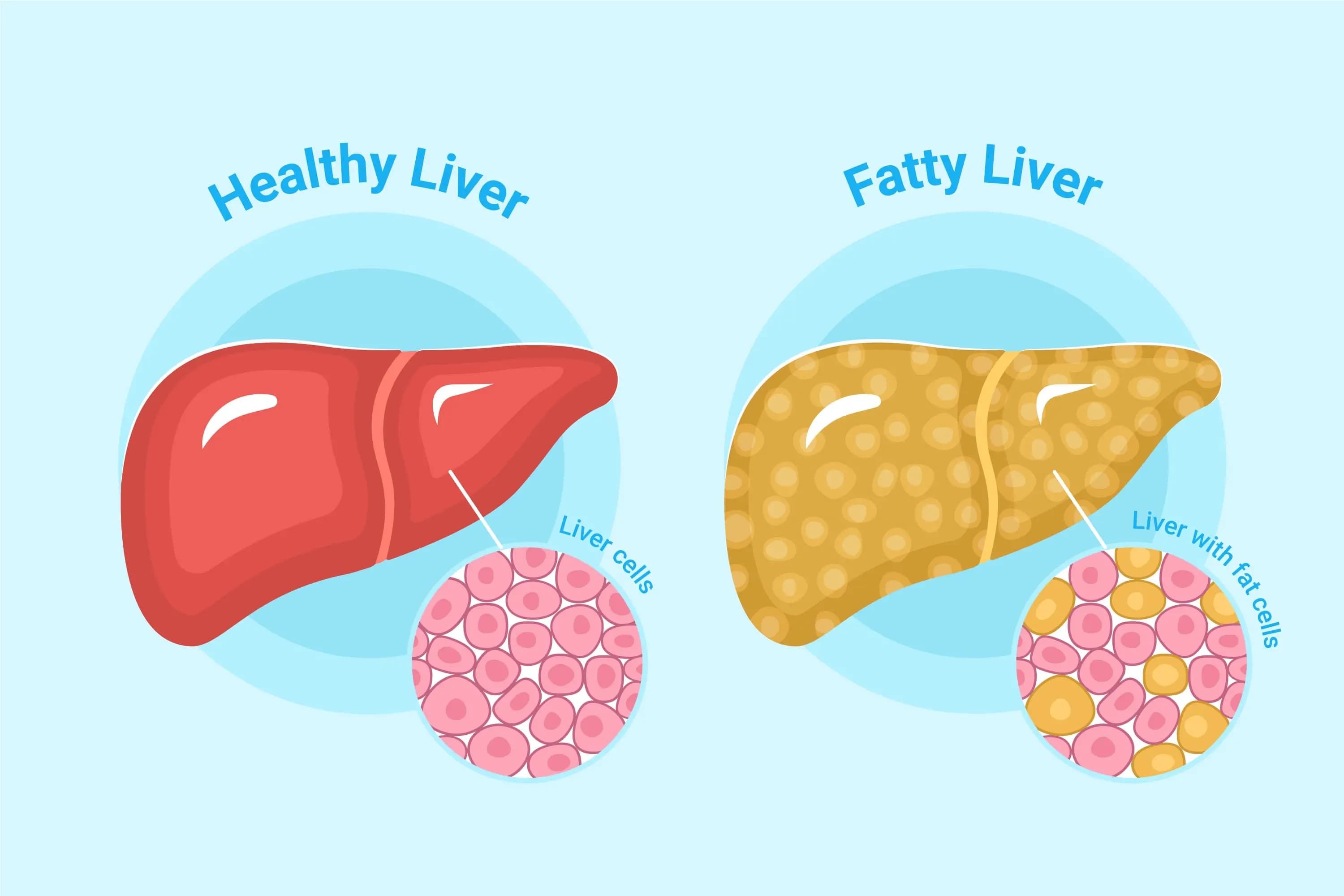 apa-itu-fatty-liver-dan-cara-mendeteksinya