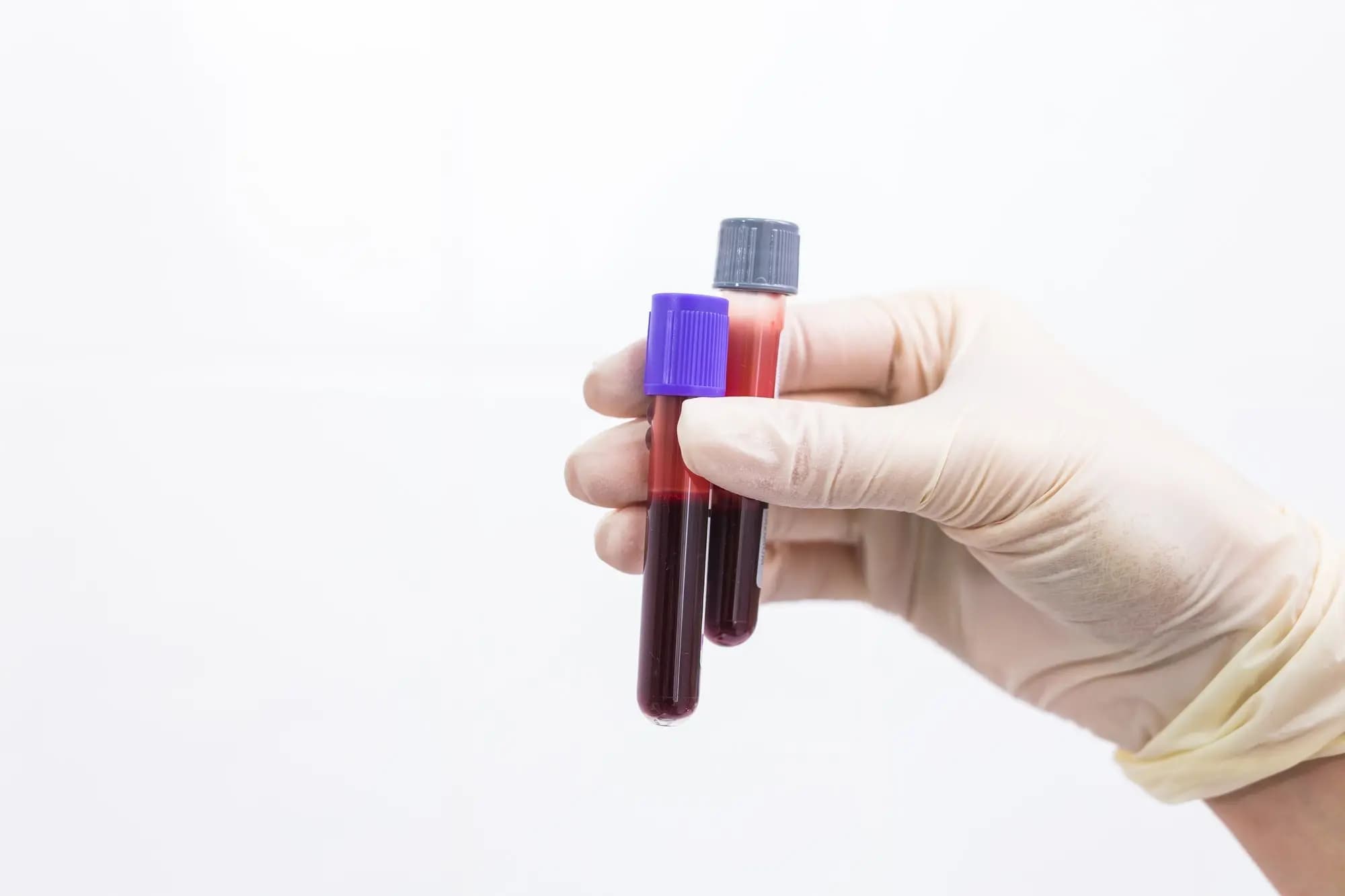 Mengenal Hepatitis C: Menular Lewat Darah, Ini Panduan Lengkapnya!